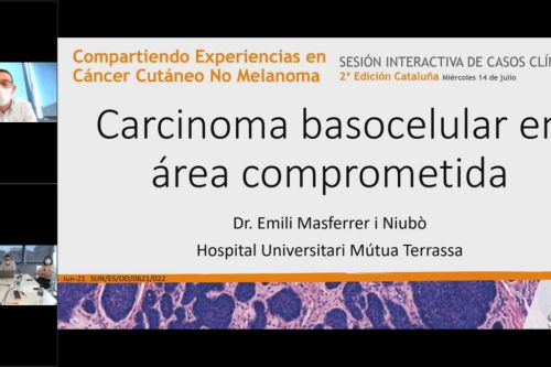 Carcinoma basocelular en área comprometida